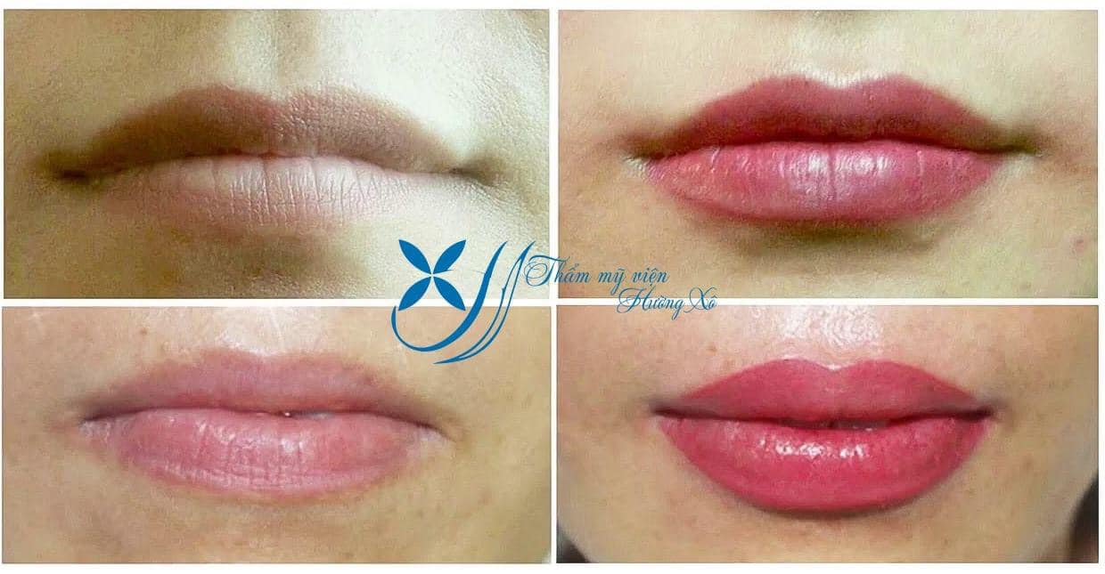 khử môi thâm tại vinh, nghệ an