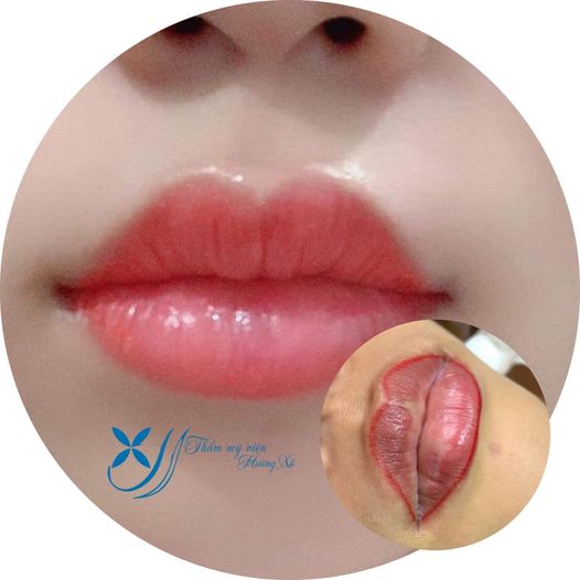 khử môi thâm tại vinh, nghệ an