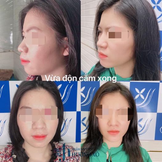 độn cằm tại vinh