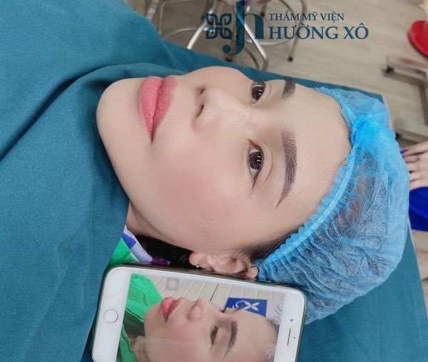 Độn cằm Vline tại Vinh