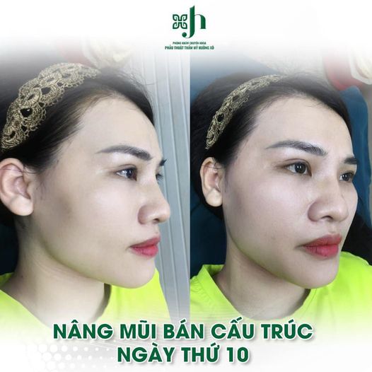 nâng mũi tại vinh
