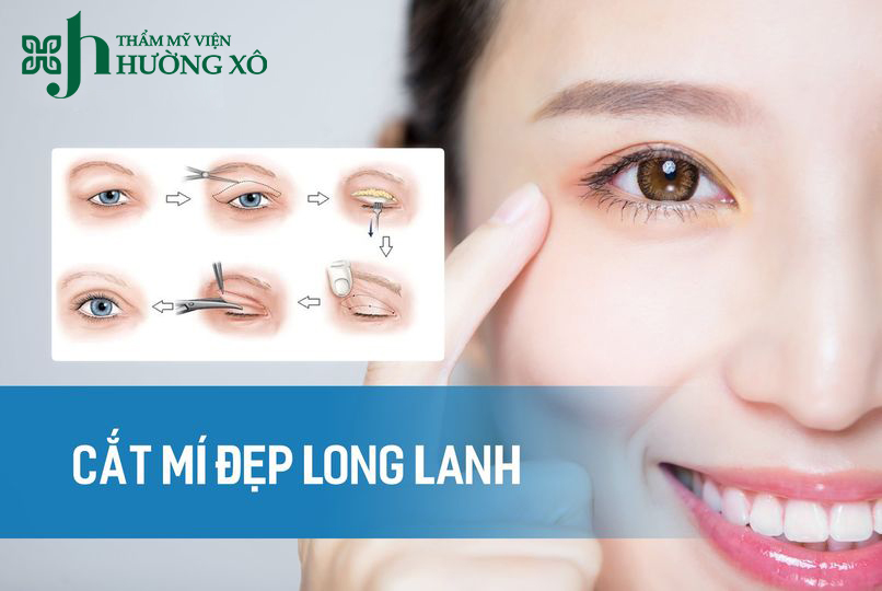 cắt mí nội soi tại vinh