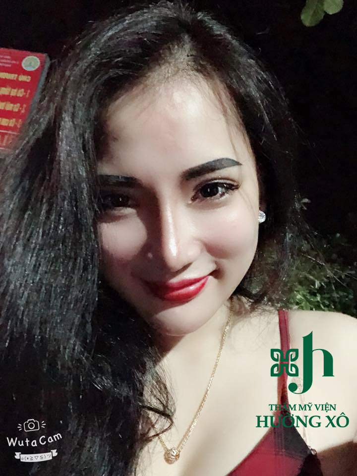 Độn cằm tại Vinh, Nghệ An