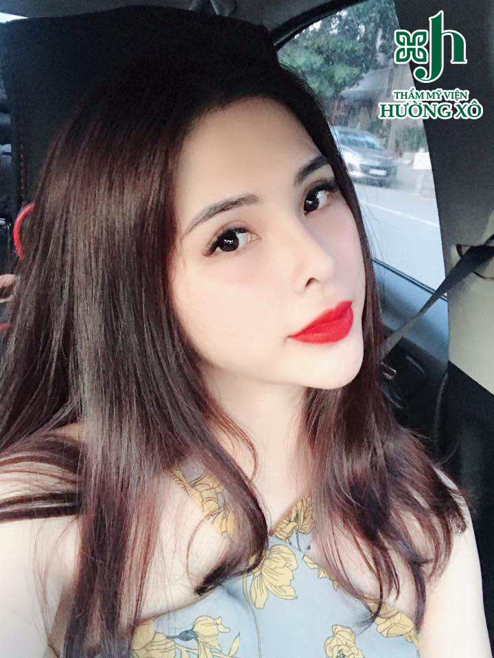 Độn cằm tại Vinh, Nghệ An