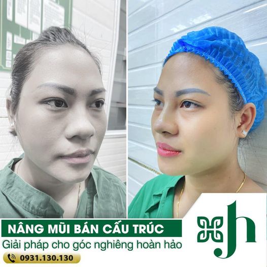 Nâng mũi bán cấu trúc tại Vinh, Nghệ An