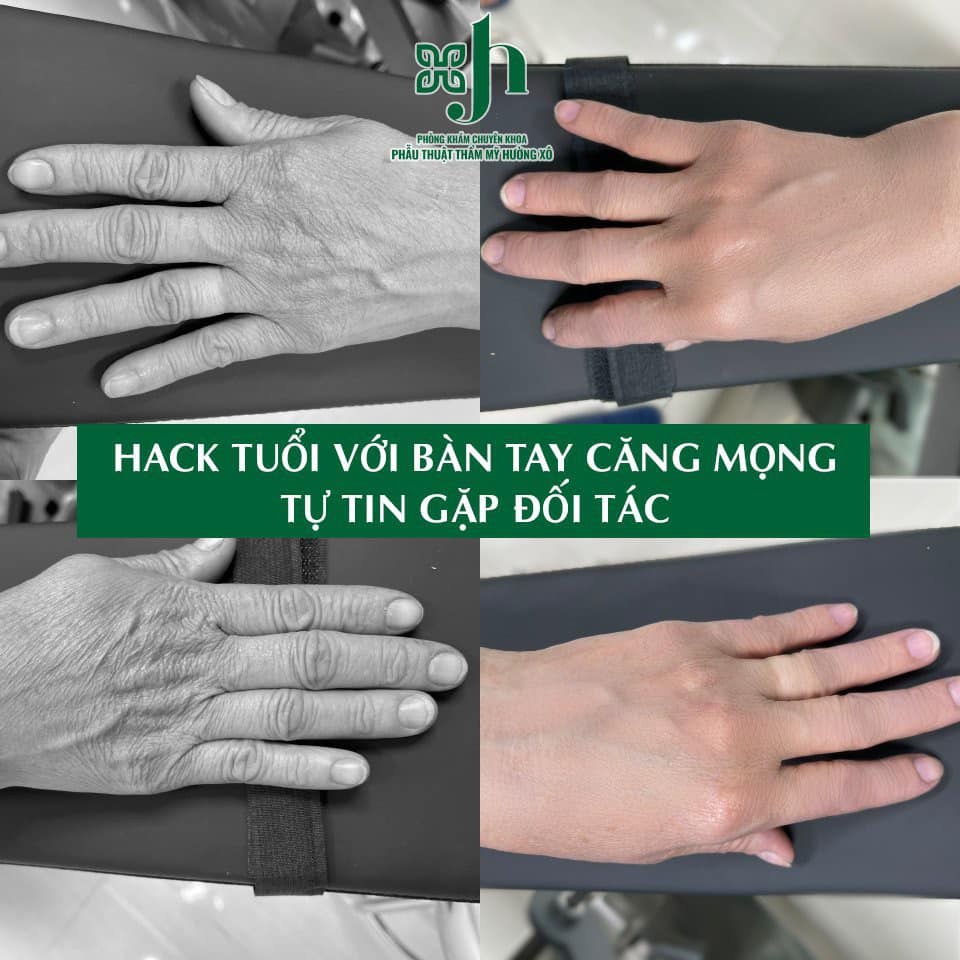 trẻ hóa bàn tay bằng filler tại vinh, nghệ an