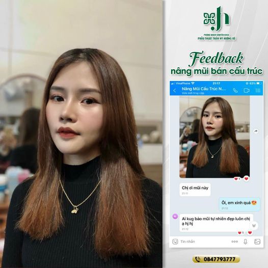 nâng mũi bán cấu trúc tại Vinh