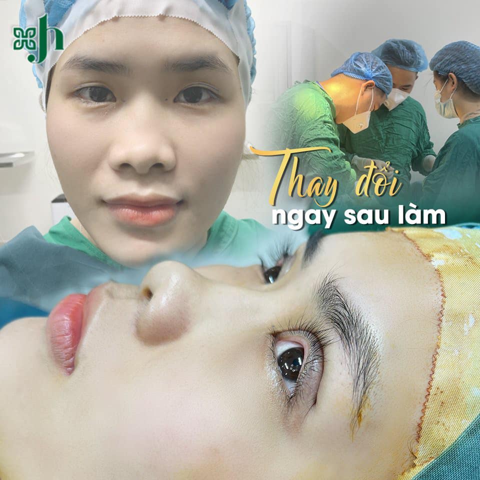 Cắt mí nội soi tại Vinh