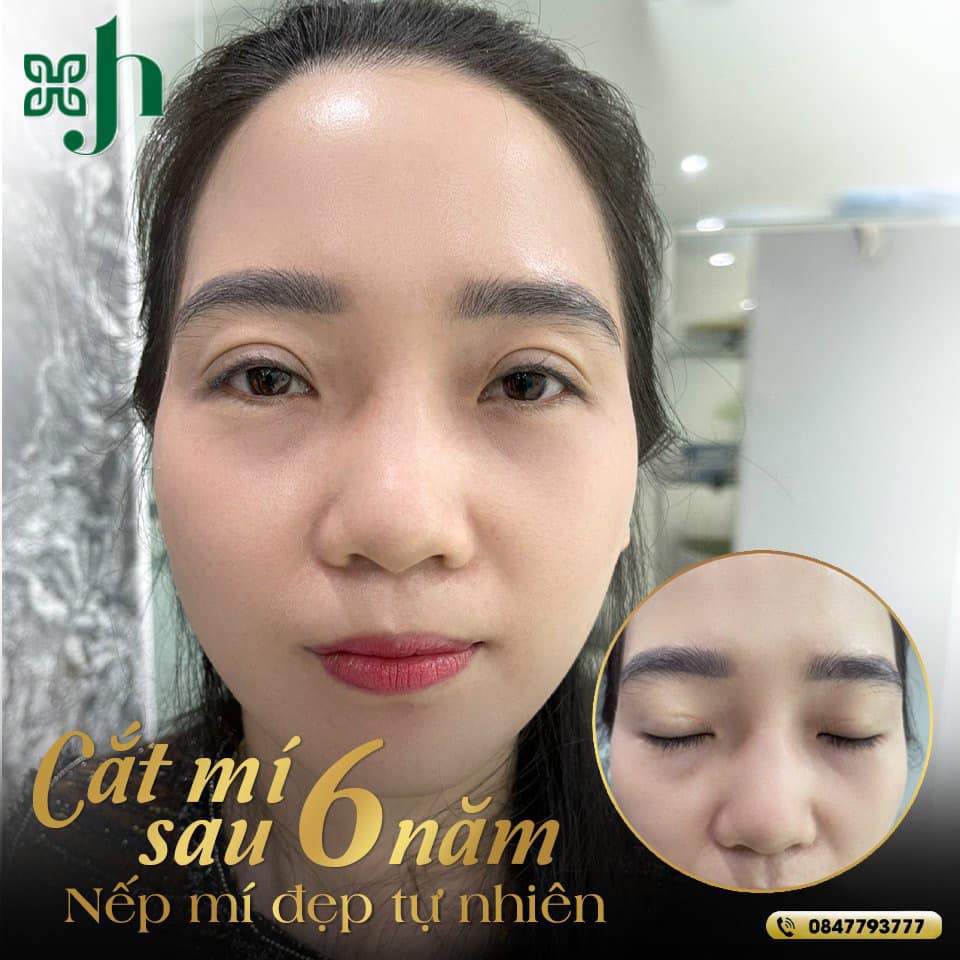 Cắt mí nội soi tại Vinh