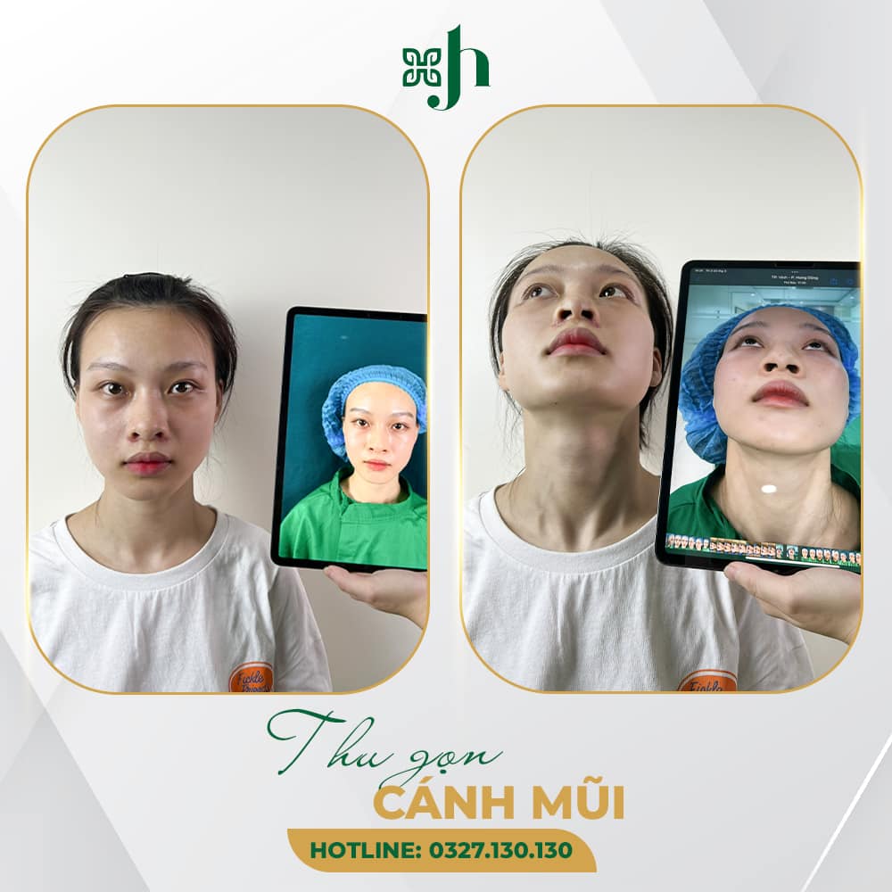 thu gọn cánh mũi tại vinh nghệ an