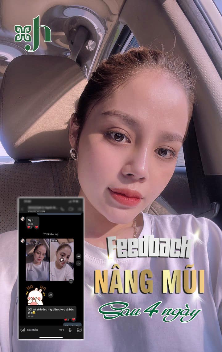 Nâng mũi bán cấu trúc tại Vinh, Nghệ An