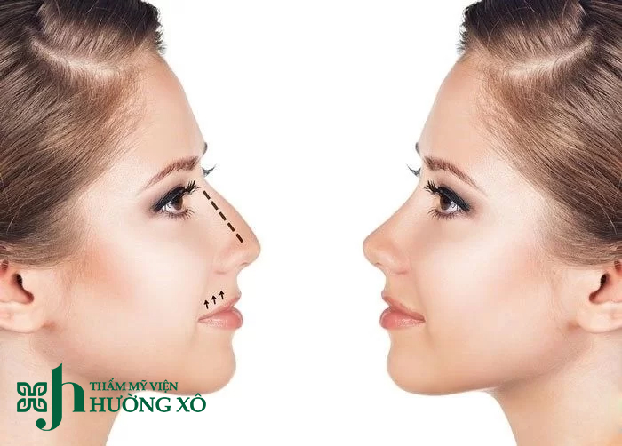 Dịch vụ mài gồ mũi tại Vinh