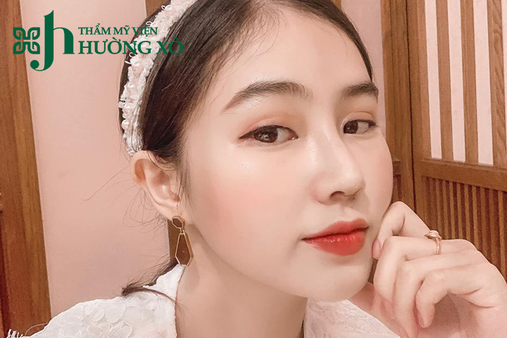 Nâng mũi cấu trúc tại Vinh