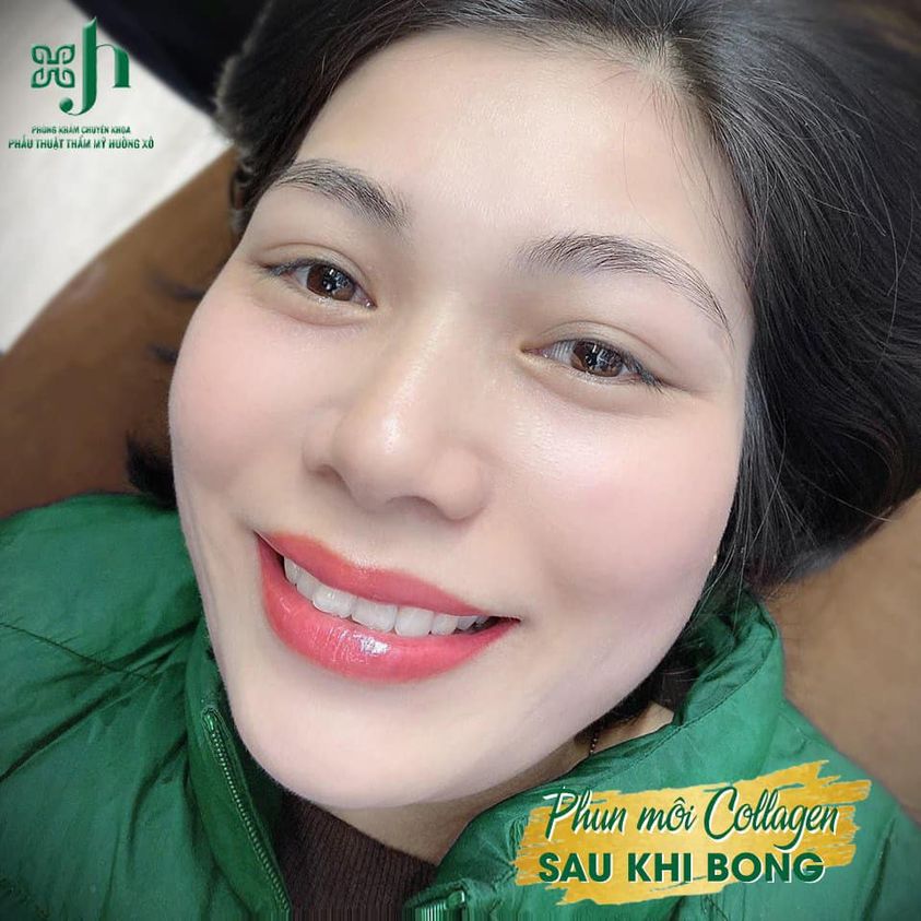 phun moi collagen tai Ha Tinh