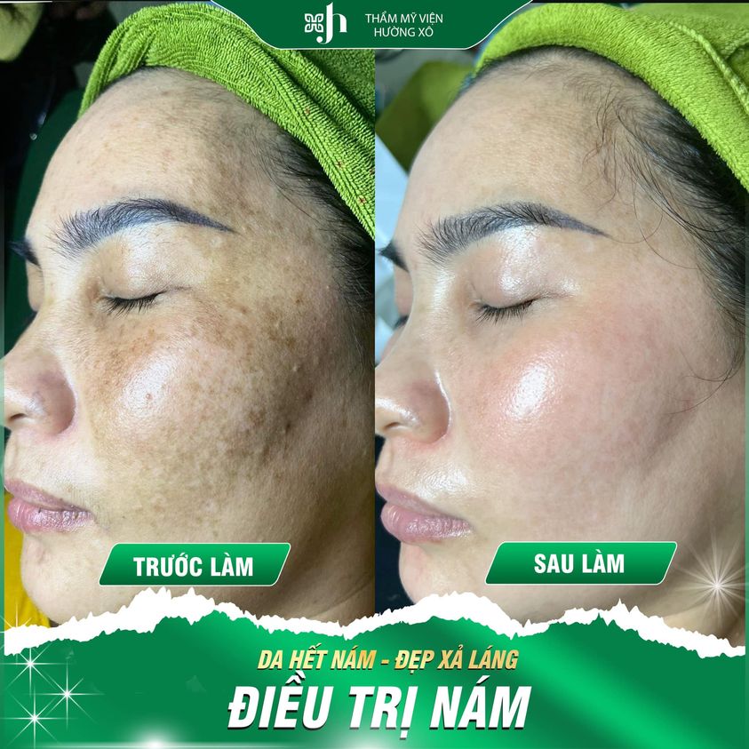 Dieu tri nam da tai Vinh