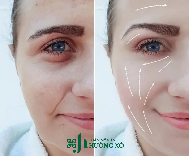 Độn rãnh cười tại Vinh