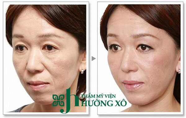 Độn rãnh cười tại Vinh