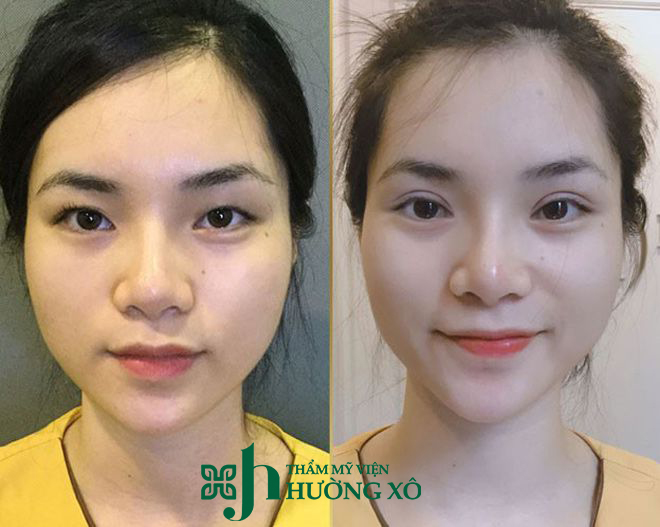 Cắt mí nội soi tại Hà Tĩnh