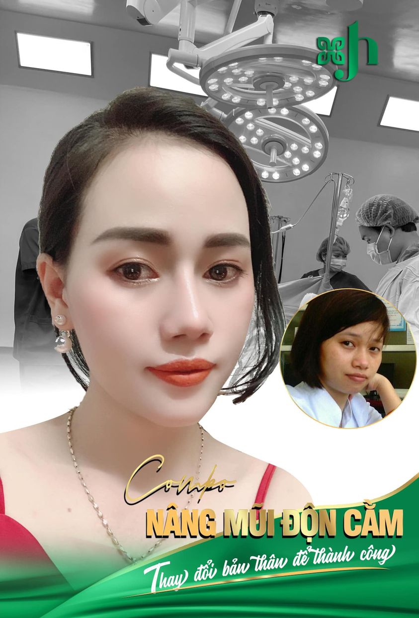 Độn cằm tại Vinh
