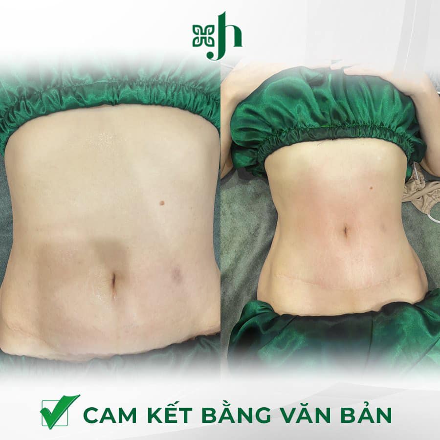 Giam beo Ultra Fit chất lượng