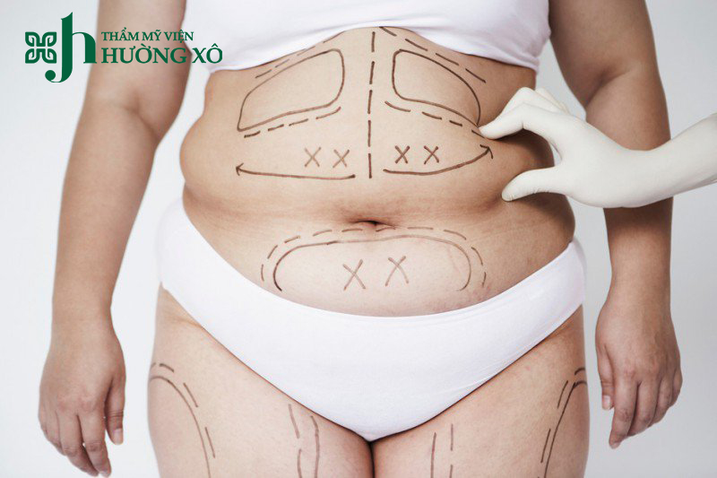 Hủy mỡ max thin lipo tại Hà Tĩnh