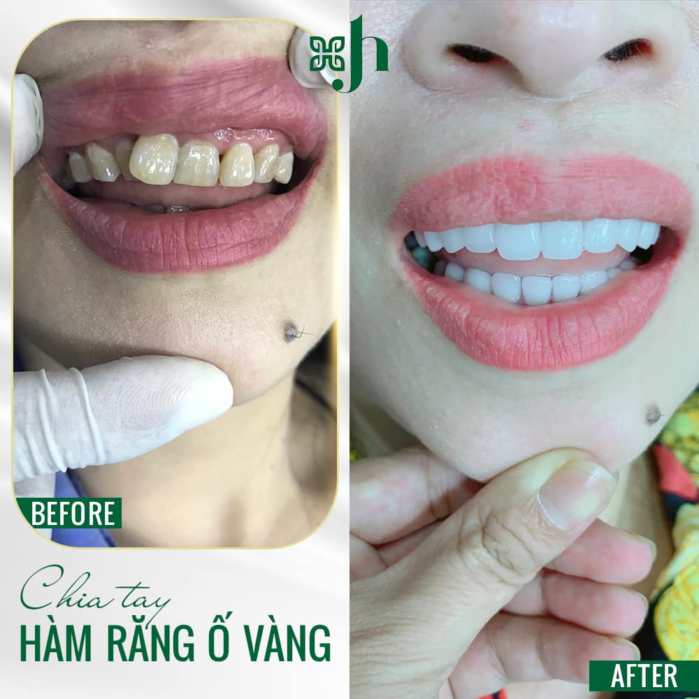 Bọc răng sứ thẩm mỹ tại Vinh
