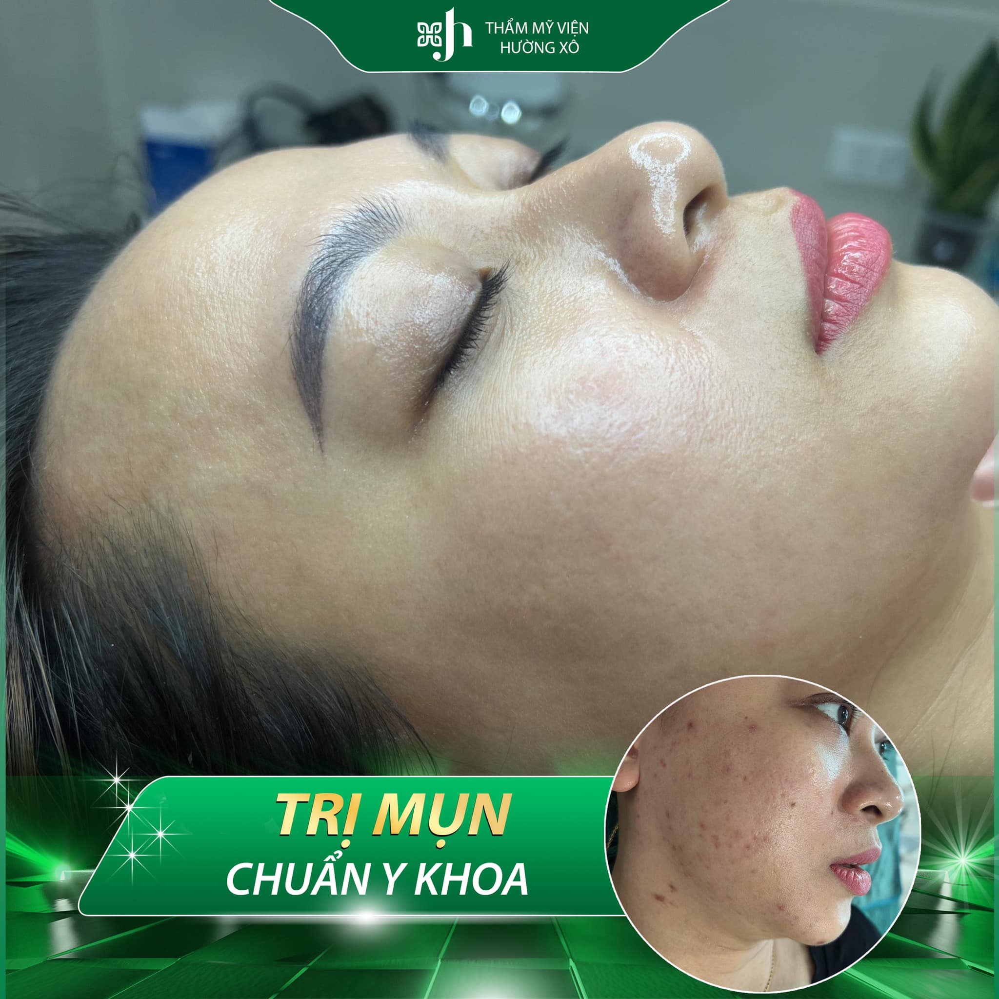Điều trị mụn, thâm mụn tại Vinh