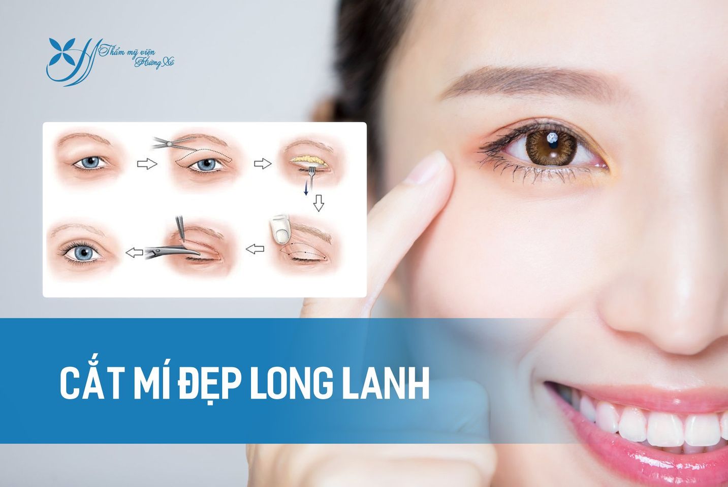 Phẫu thuật sụp mí mắt