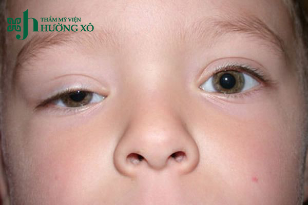 sụp mí mắt tại Hà Tĩnh