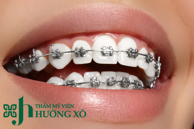 Niềng răng tại Vinh