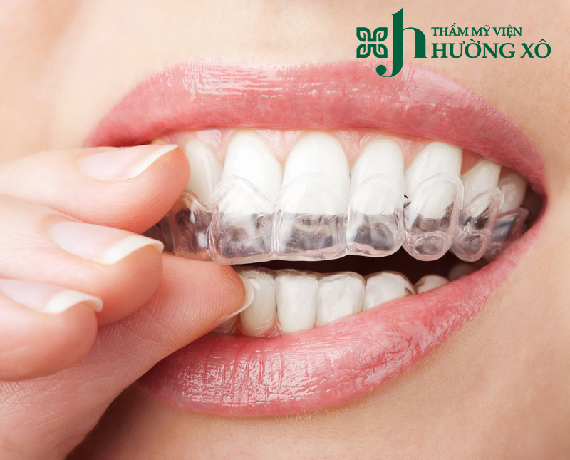 niềng răng tại Vinh