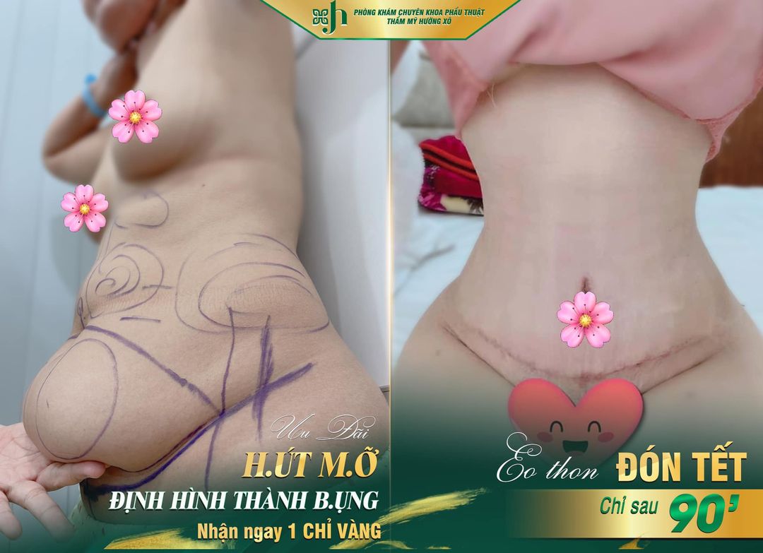 Hút mỡ bụng tại Nghệ An