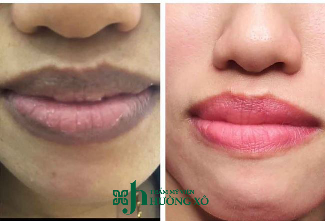 Khử thâm môi uy tín tại Hà Tĩnh