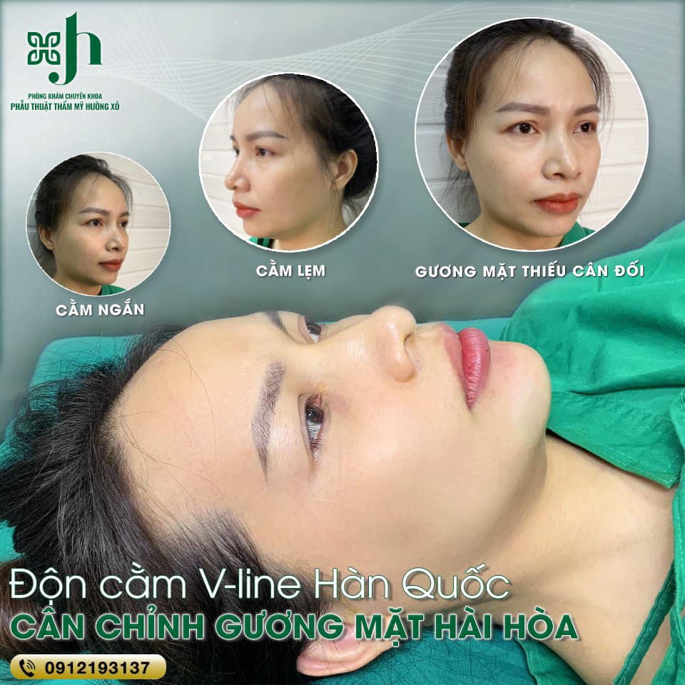 Đồn cằm uy tín tại Hà Tĩnh
