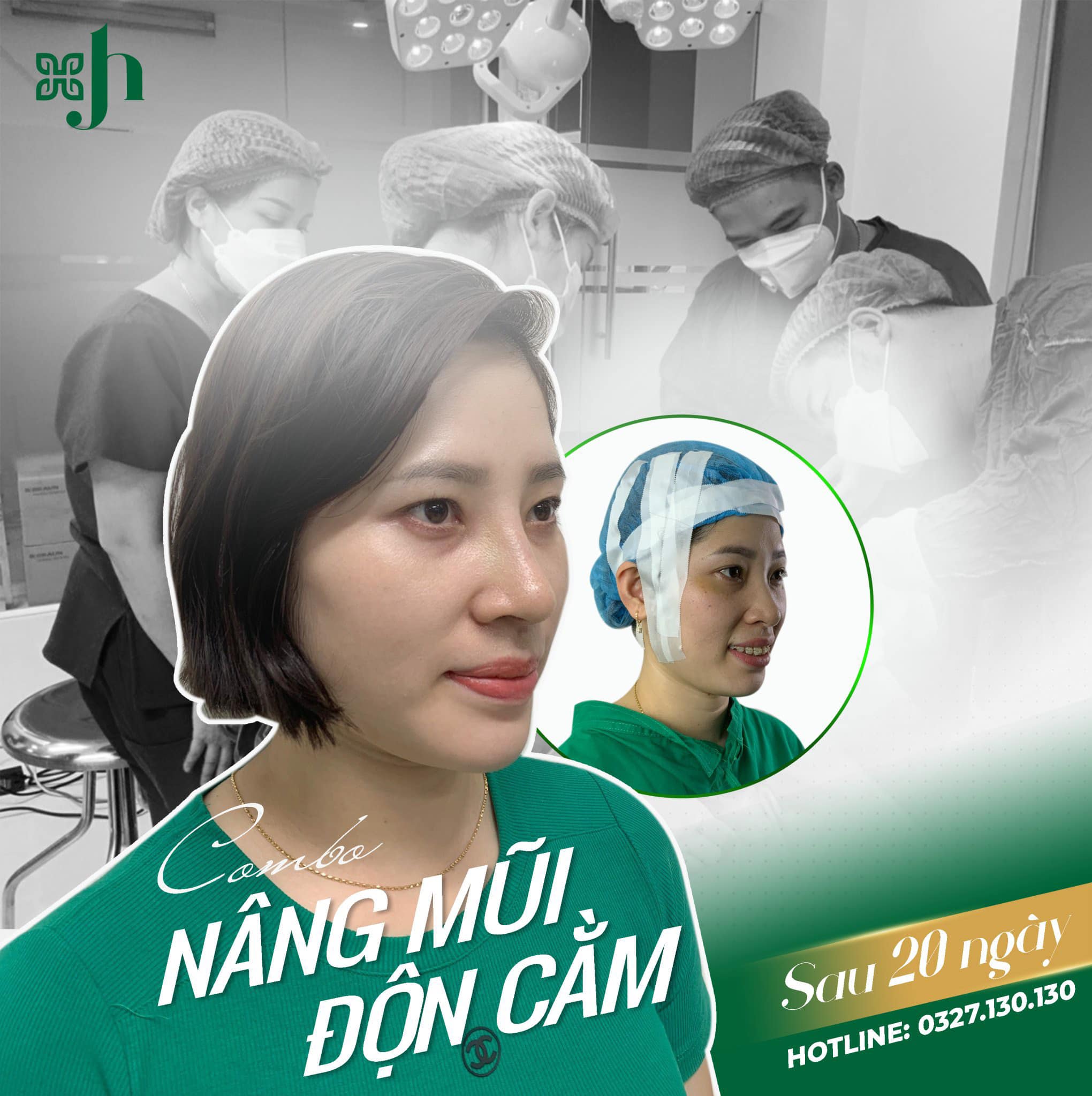 Độn cằm uy tín tại Hà Tĩnh