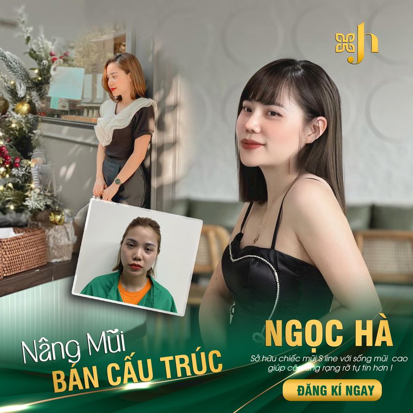 Nâng mũi bán cấu trúc tại Hà Tĩnh