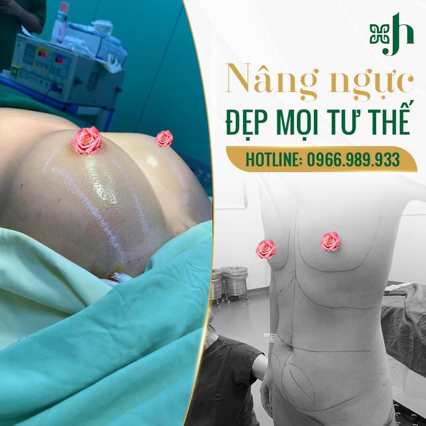 Nâng ngực không chạm tại Vinh