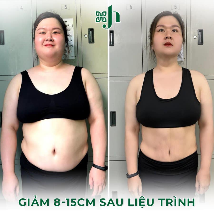 Giảm béo Smart Lipo tại Hà Tĩnh