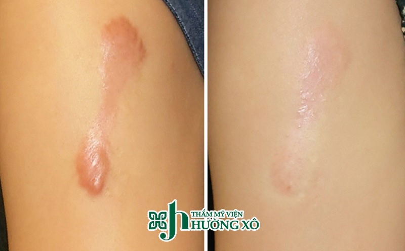 Tiêm sẹo lồi tại Vinh