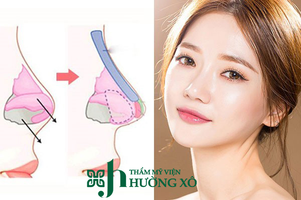 Nâng mũi bọc sụn tại Vinh