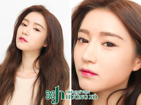 Cắt mí nội soi tại Hà Tĩnh