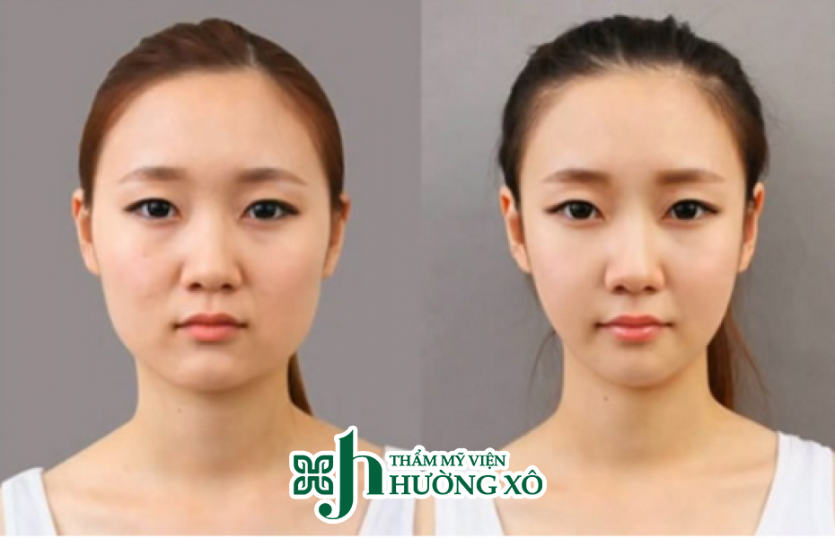 Nâng cơ Hifu tại Hà Tĩnh