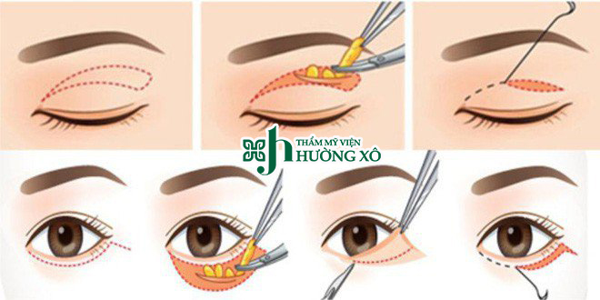 Lấy mỡ mí mắt trên tại Vinh