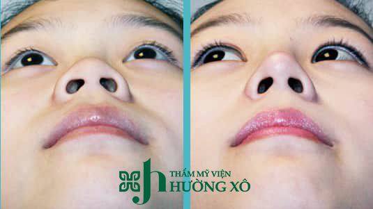 thu gọn cánh mũi tại Hà Tĩnh