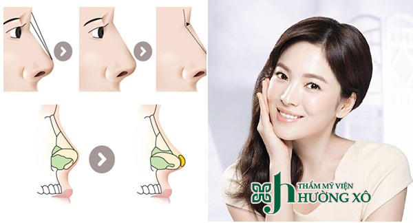 Nâng mũi Hàn Quốc tại Hà Tĩnh