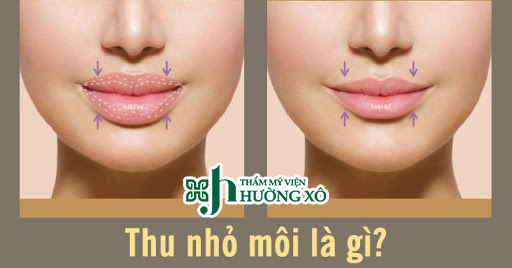 thu gọn môi tại Vinh