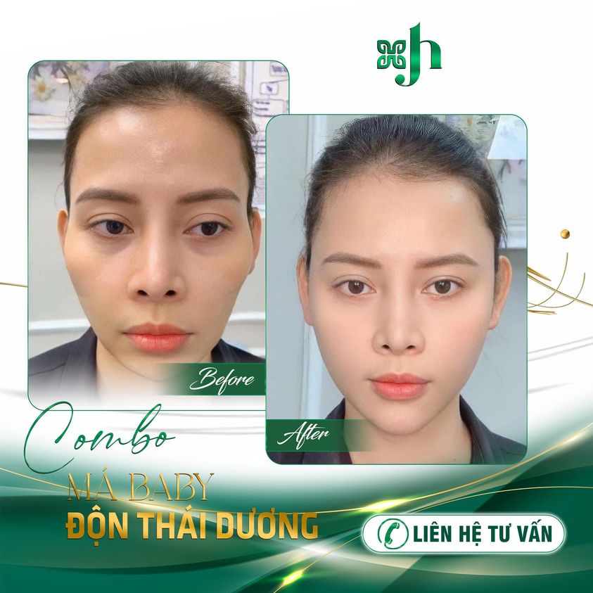 tiêm má baby tại Vinh