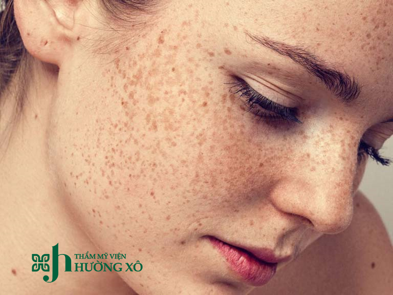 Điều trị tàn nhang uy tín tại Hà Tĩnh