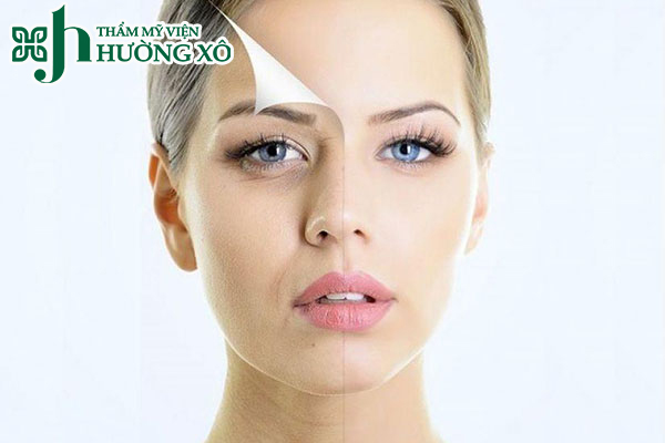 Nâng cơ Hifu tại Vinh