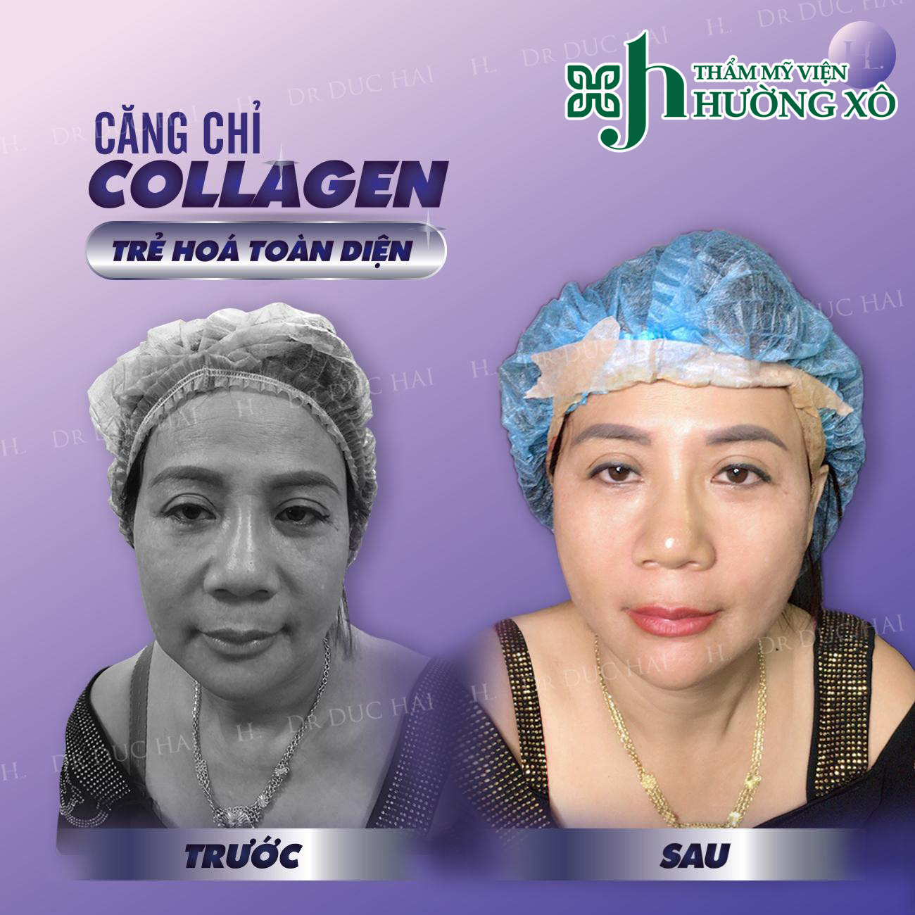 Căng chỉ collagen tại Hà Tĩnh